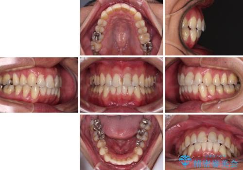 ワイヤー装置をインビザラインへ 装置変更での矯正治療の治療後