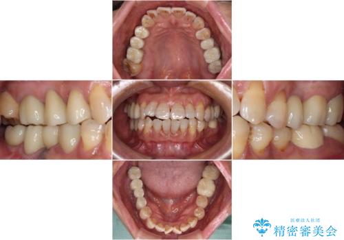 治療後に歯茎から出血 インプラントとオールセラミッククラウンの補綴治療の治療後