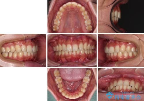 前歯のデコボコをスッキリ改善 インビザライン矯正の治療後