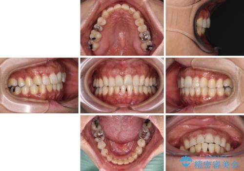 インビザラインでのんびりと矯正治療 の治療後