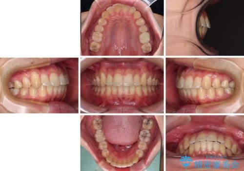 前歯のデコボコを治したい ワイヤー装置でお手軽に矯正治療の治療後