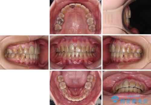 八重歯とクロスバイト 目立たないワイヤー装置での抜歯矯正の治療後