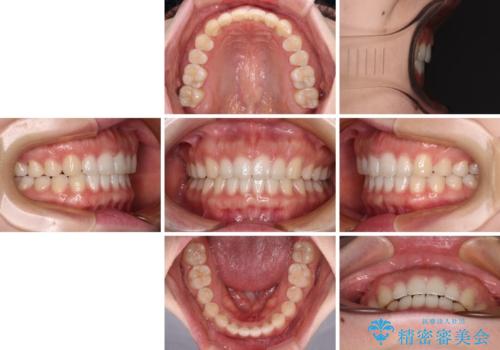 すきっ歯とオープンバイト インビザライン・ライトで改善の治療後