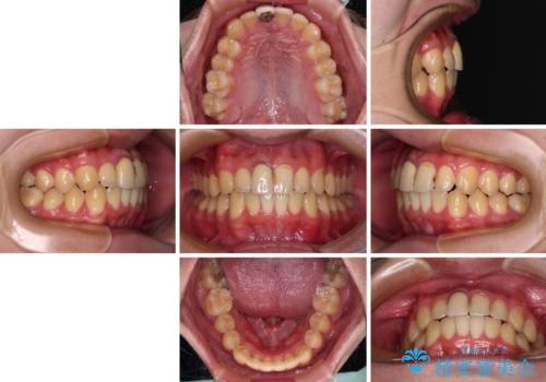 前歯のデコボコを治したい インビザライン矯正治療の治療後