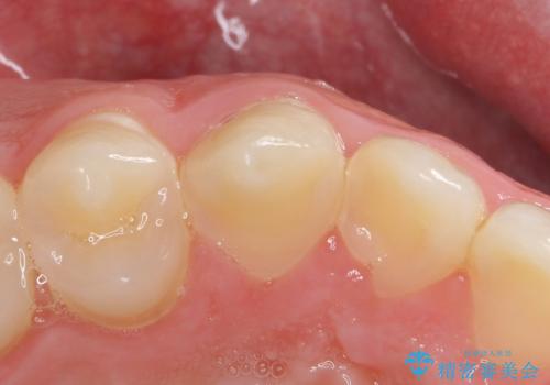 穴が開いた前歯 白いクラウンで修復の治療前