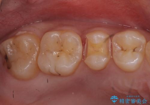 症状のない虫歯 セラミックインレーでの治療の治療中