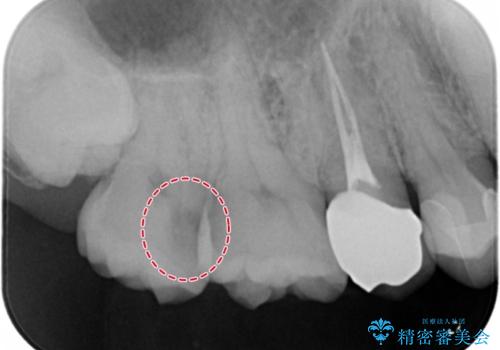 放置していた虫歯 セラミックインレーによる治療