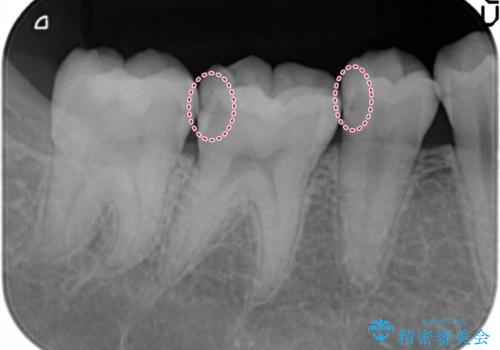 隠れているむし歯 セラミックインレーによる治療の治療前