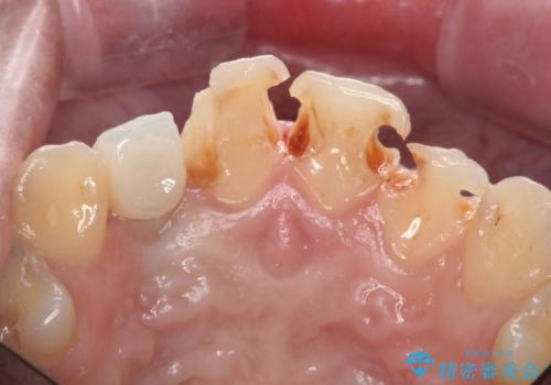 前歯の虫歯 オールセラミック治療の治療中