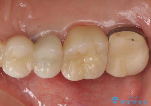 時々しみる奥歯 適合の悪いインレーからクラウンへのやり替えの治療後