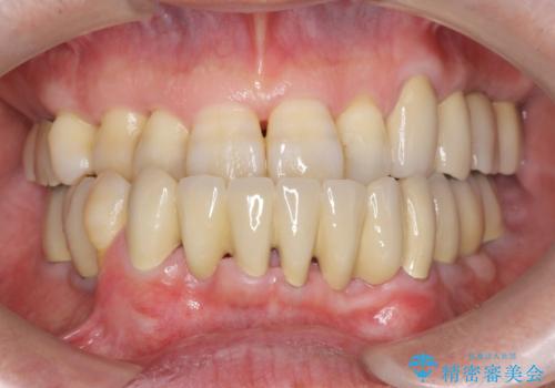 インプラント治療を併用した全顎歯周病治療の症例 治療後