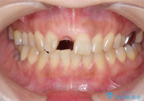 骨造成を伴う前歯のインプラント治療の治療前