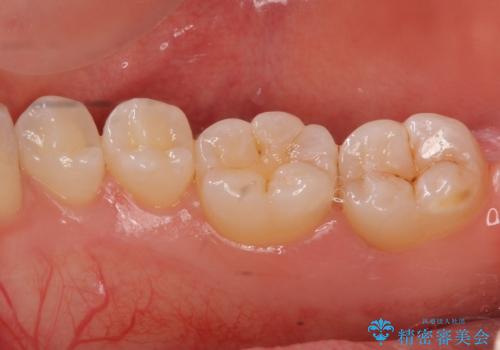 奥歯の虫歯 セラミックインレーによる治療の治療前