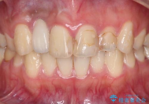 前歯の虫歯　オールセラミック治療の治療前