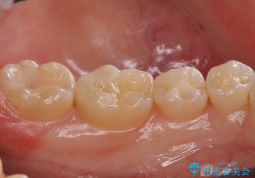 隠れているむし歯 セラミックインレーによる治療の治療後