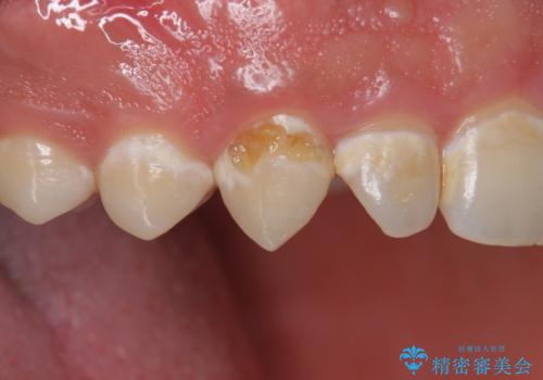 穴が開いた前歯 白いクラウンで修復の症例 治療前
