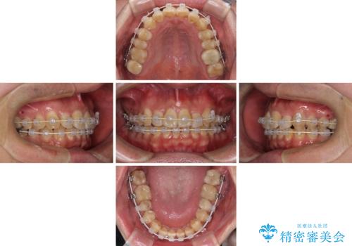 やっぱり矯正をしたい　セラミック治療の途中から矯正治療スタートの治療中