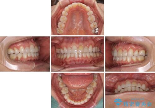 矯正治療の後戻り インビザライン・ライトでの再矯正の治療中