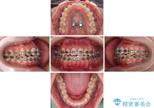 急速拡大装置 狭い上顎骨を拡大してワイヤー装置で短期間治療の治療中