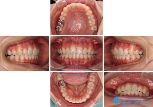 転勤予定がある インビザラインによる矯正治療の治療中