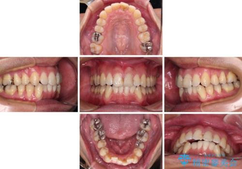 ワイヤー装置をインビザラインへ 装置変更での矯正治療の治療中