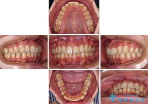 前歯のデコボコをスッキリ改善 インビザライン矯正の治療中