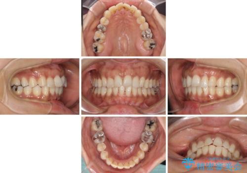 インビザラインでのんびりと矯正治療 の治療中