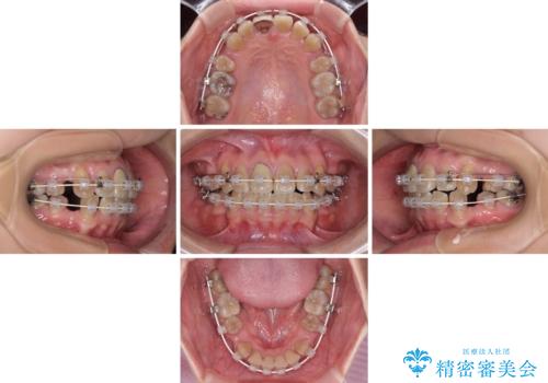 八重歯とクロスバイト 目立たないワイヤー装置での抜歯矯正の治療中