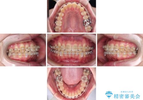 前歯のデコボコを治したい ワイヤー装置でお手軽に矯正治療の治療中