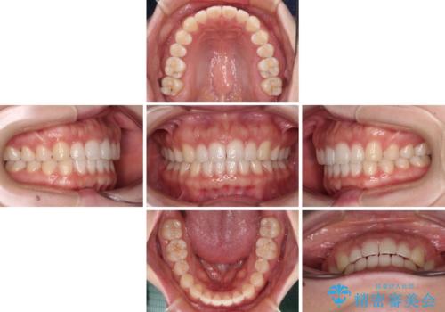 すきっ歯とオープンバイト インビザライン・ライトで改善の治療中