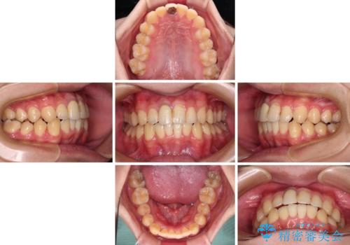 前歯のデコボコを治したい インビザライン矯正治療の治療中