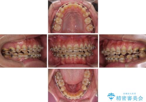 隙間が空いて突出した前歯を治したい ワイヤー装置による抜歯矯正の治療中