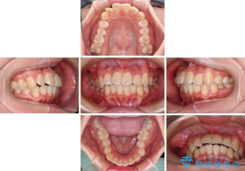 【モニター】八重歯と前歯のクロスバイト ワイヤーを併用しインビザラインで矯正治療の治療中