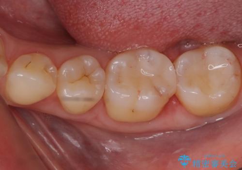 治療途中で放置した奥歯 セラミックインレーでの修復の治療後