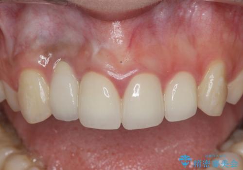 前歯の虫歯　オールセラミック治療の治療後
