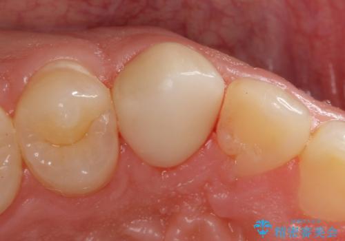 穴が開いた前歯 白いクラウンで修復の治療後