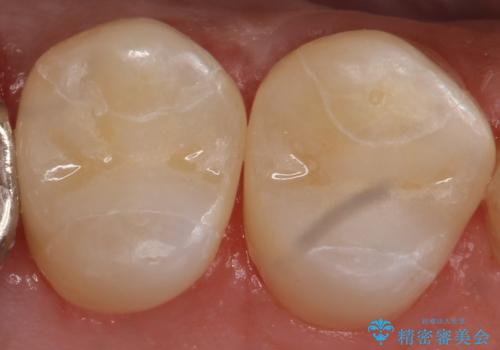 外から見える銀歯 セラミックでのやり替えの治療後