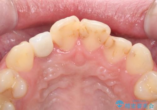 前歯の虫歯 オールセラミック治療の治療前