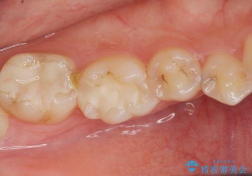 検査で見つかった虫歯　セラミックインレーでの修復の症例 治療前