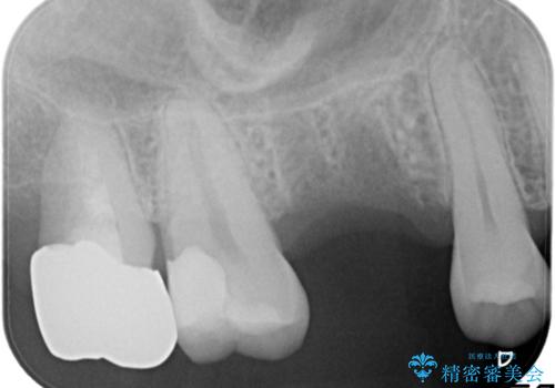 欠損している歯をインプラント治療により元のように咬めるようにの治療前