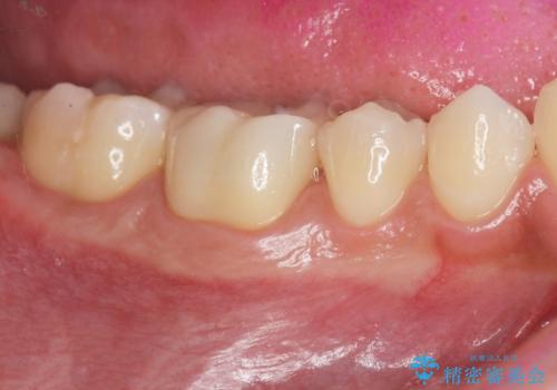 放置してしまった虫歯の治療の治療後