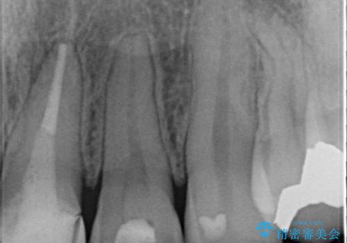 矯正治療が終了し、前歯を治したいの治療前