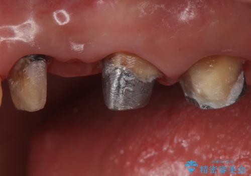 銀歯を白くしたい セラミックブリッジでの治療の治療中