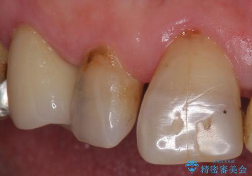 大きい虫歯で欠けた前歯 セラミッククラウンで治療の治療前