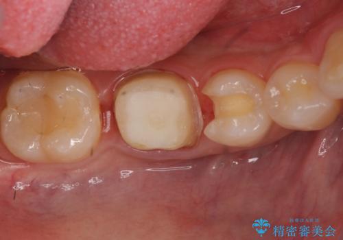銀歯のやり替え セラミックで白い歯にの治療中