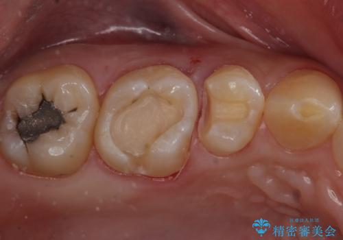 たまにしみる奥歯 セラミックインレーでの修復の治療中