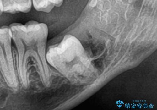 矯正前の親知らず抜歯(埋伏)の治療後