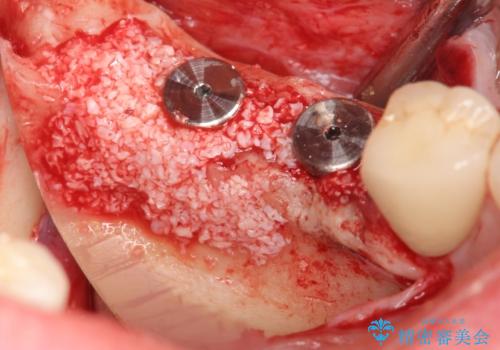 臼歯部インプラント治療の治療中