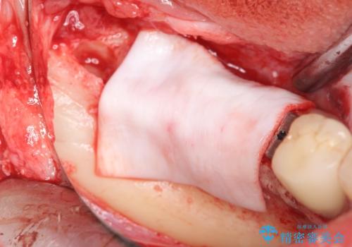 臼歯部インプラント治療の治療中