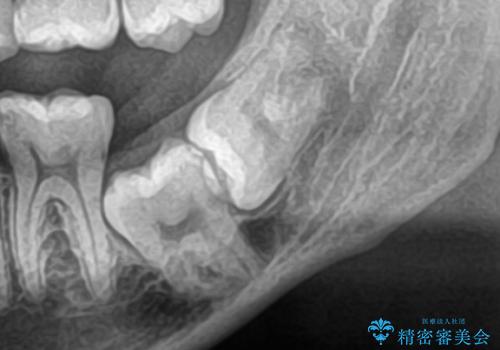 矯正前の親知らず抜歯(埋伏)の症例 治療前